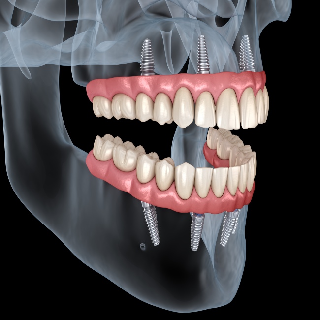 All-on-4 Dental Implants in Phoenix, AZ