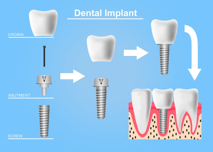 Structure of types of dental implant in Northern Phoenix, AZ