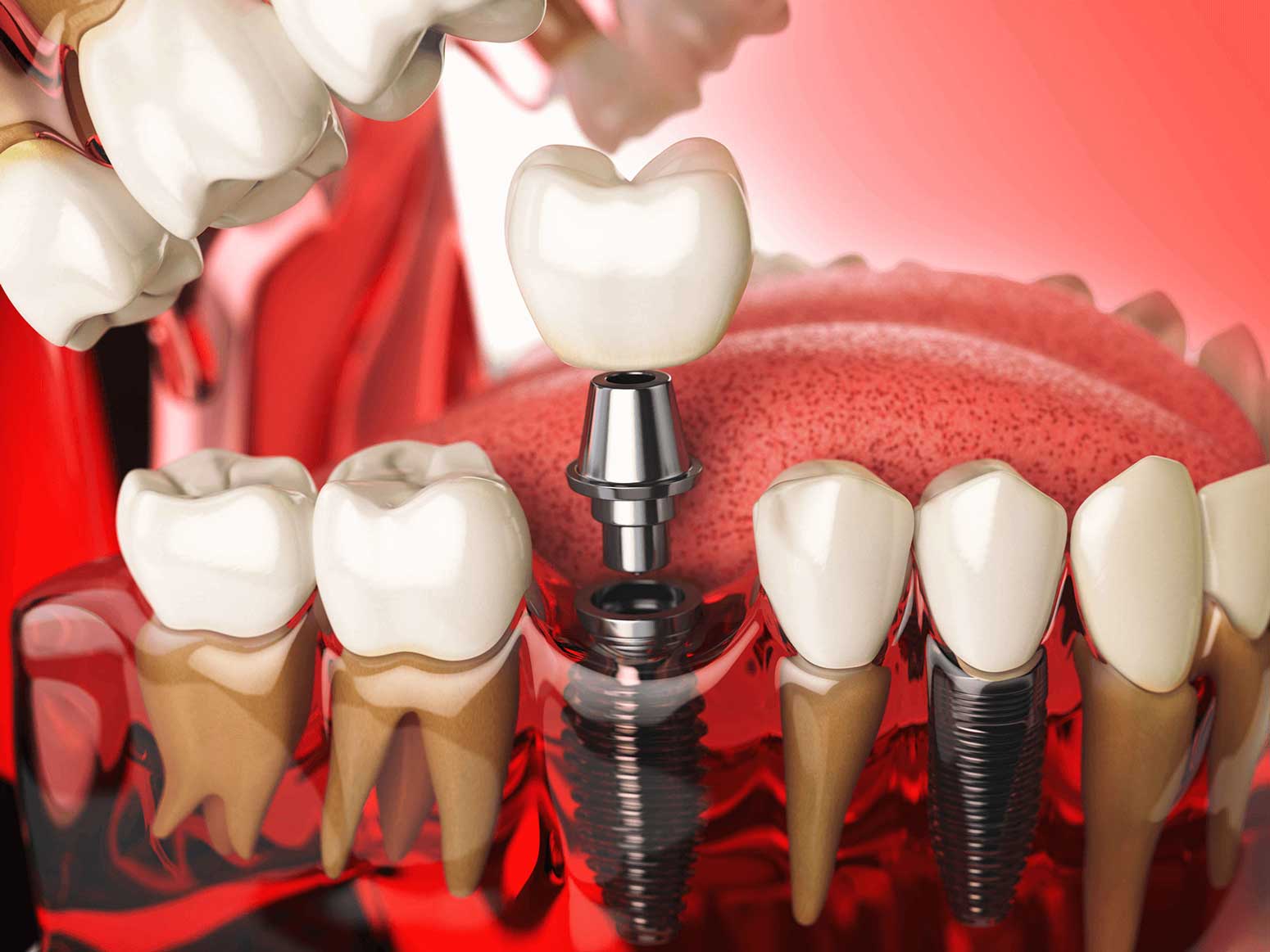 Bone-Grafting-in-Dental-Implant(for-Desert-Ridge)