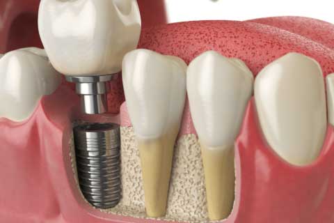 Bone-Grafting-in-Dental-Implant(for-Paradise-Valley-Village)
