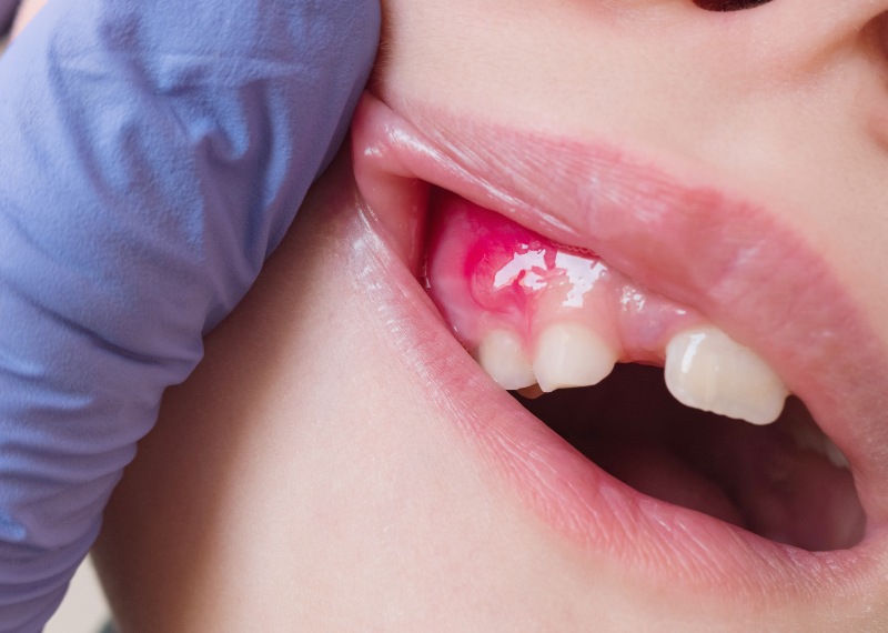 A kid fighting with tooth extraction infection in North Phoenix, AZ